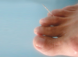 Nova tcnica de acupuntura para estmago e enxaqueca