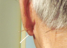 Nova tcnica de acupuntura para tratamento de surdez e zumbido no ouvido