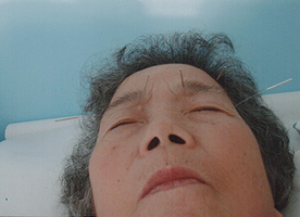 Tratamento de acupuntura para Catarata e Glaucoma