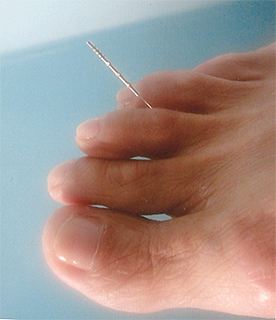 Nova tcnica de acupuntura para Estmago e enxaqueca