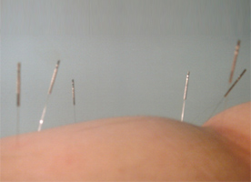 Tratamento de acupuntura para menstruao e estmago